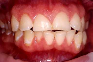 carii incisivi - demineralizare smalt dentar