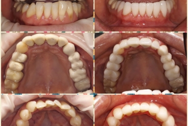 fatete portelan - coroane dentare ceramice