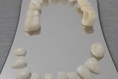 fatete portelan - coroane dentare ceramice