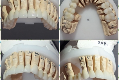 fatete portelan - coroane dentare ceramice