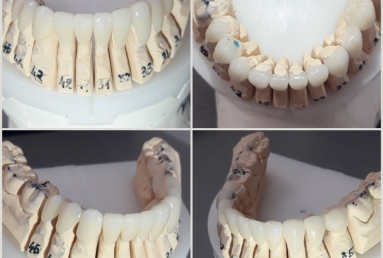 fatete portelan - coroane dentare ceramice