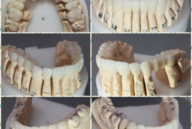 fatete portelan - coroane dentare ceramice