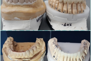 fatete portelan - coroane dentare ceramice