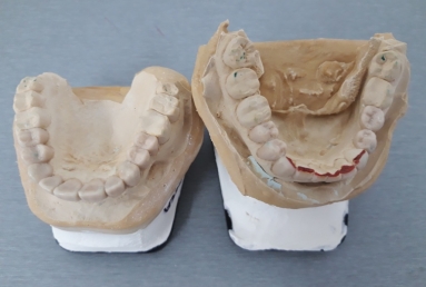 fatete portelan - coroane dentare ceramice