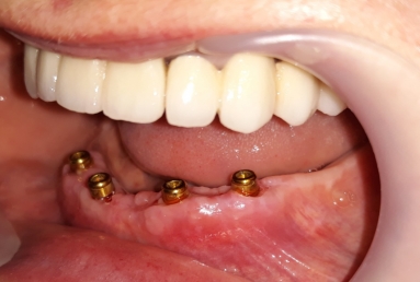 restaurare arcada dentara implant dentar