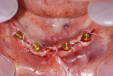 restaurare arcada dentara implant dentar