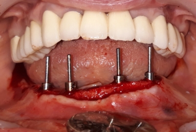 restaurare arcada dentara implant dentar