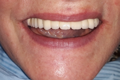 restaurare arcada dentara implant dentar