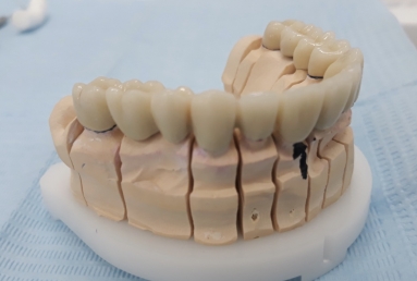 restaurare arcada dentara implant dentar