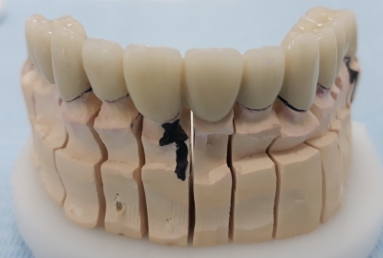 restaurare arcada dentara implant dentar