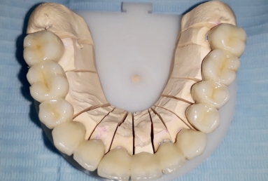 restaurare arcada dentara implant dentar