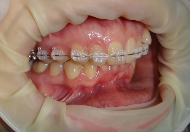 Aparat ortodontic safir