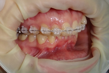 Aparat ortodontic safir