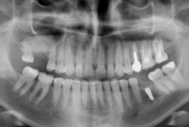 fatete ceramice - implant dentar