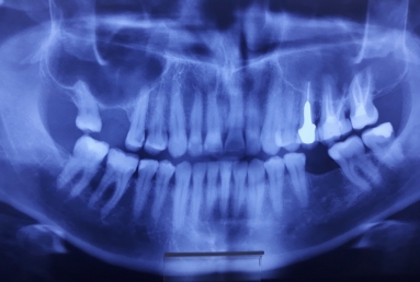 fatete ceramice - implant dentar