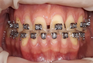 fatete ceramice - implant dentar
