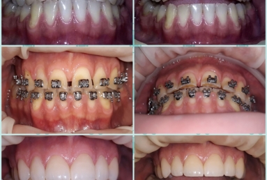 fatete ceramice - implant dentar