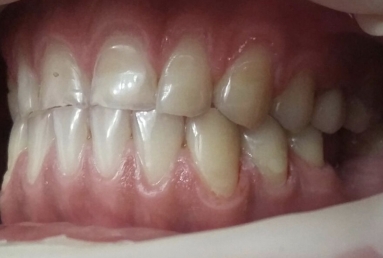 fatete ceramice - implant dentar