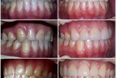 fatete ceramice - implant dentar