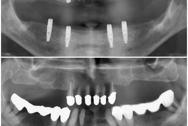 proteze fixate pe cate 4 implanturi