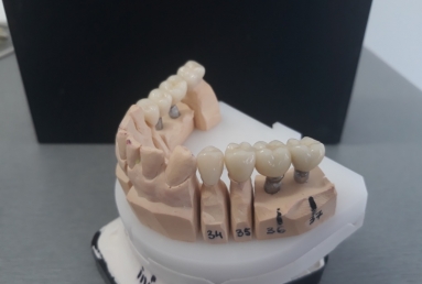 implanturi si coroane ceramice  Vezi imaginea