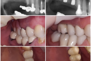 implanturi si coroane ceramice  Vezi imaginea