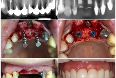 implanturi si coroane ceramice  Vezi imaginea