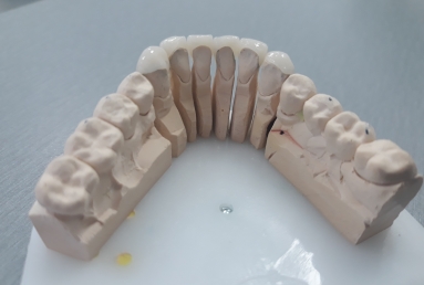 fatetarea dintilor frontali inferiori