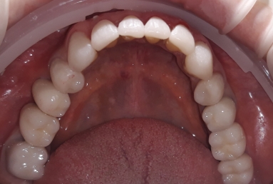 fatetarea dintilor frontali inferiori