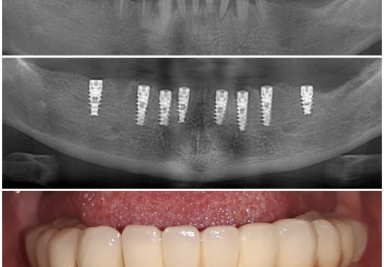 Punti metaloceramice pe implanturi Alpha Bio