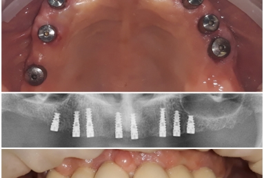 Reabilitare totala cu implanturi si lucrari fixe cimentate metaloceramice