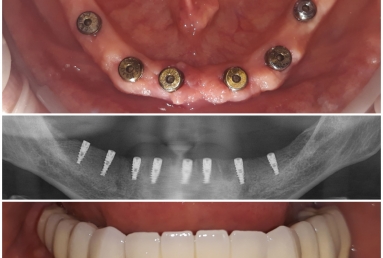 Reabilitare totala cu implanturi si lucrari fixe cimentate metaloceramice