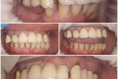 Reabilitare totala cu implanturi si lucrari fixe cimentate metaloceramice