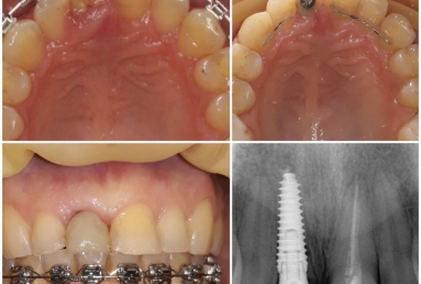 implant dentar Megagen Anyridge