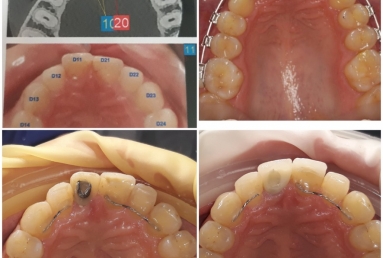 implant dentar Megagen Anyridge