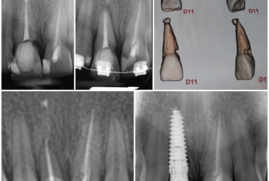 implant dentar Megagen Anyridge