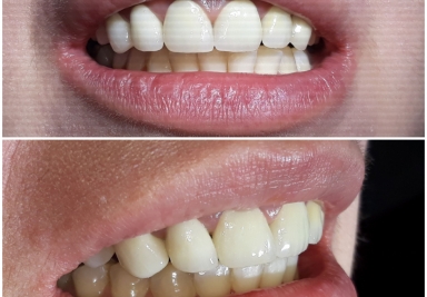 Coroane ceramice pe zirconiu pe dinti si implanturi