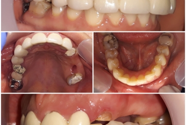 Coroane ceramice pe zirconiu pe dinti si implanturi  Vezi imaginea