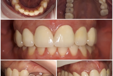 Coroane ceramice pe zirconiu pe dinti si implanturi  Vezi imaginea