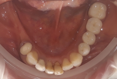 Fatete si coroane ceramice pe dinti si implanturi  Vezi imaginea