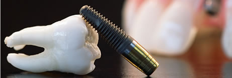 implant dentar